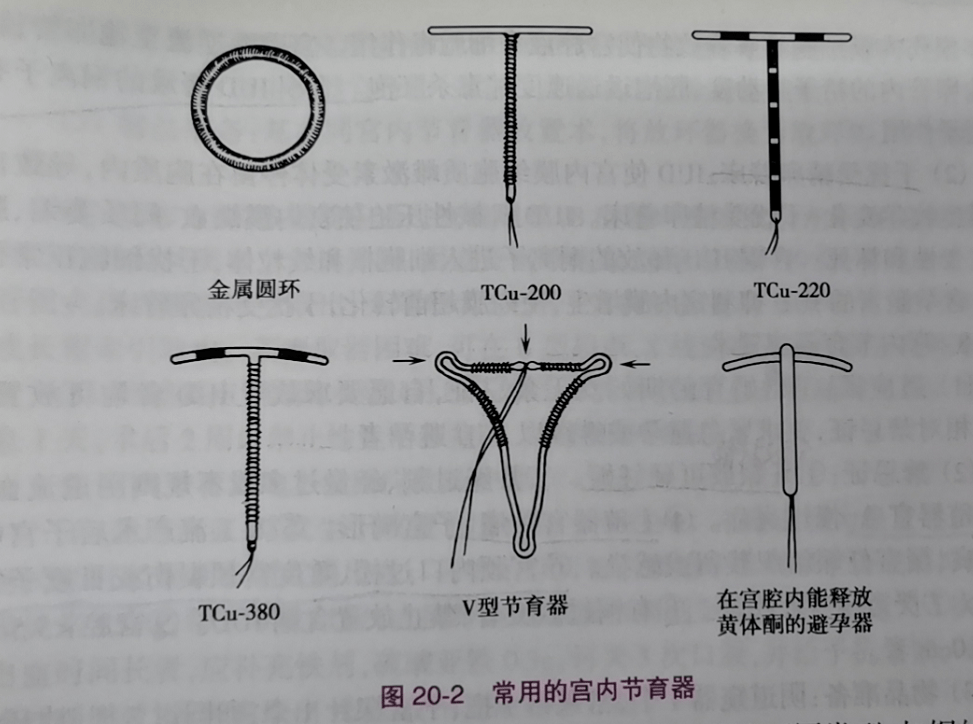 節(jié)育器的技術革新與應用前景展望